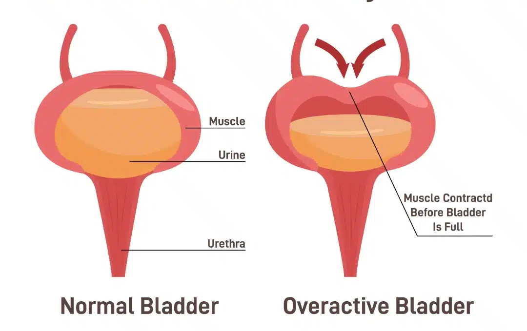 Urinary Tract Infections : Prevention and Home Care Tips