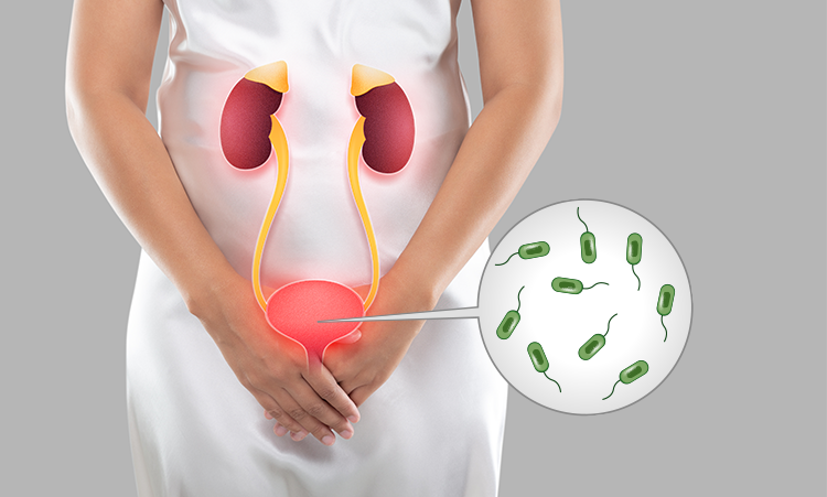 Urinary Tract Infections : Prevention and Home Care Tips
